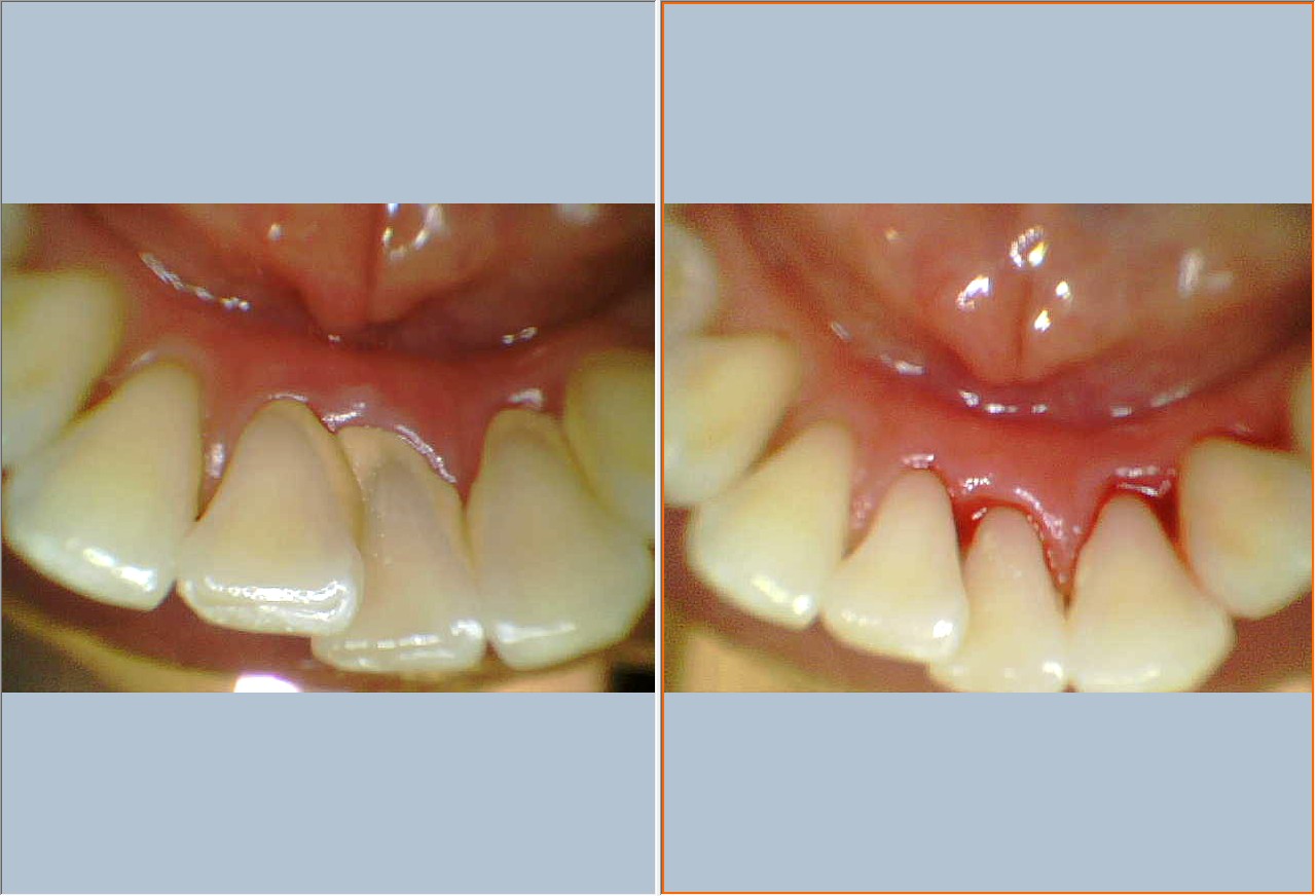 dental-scaling-1